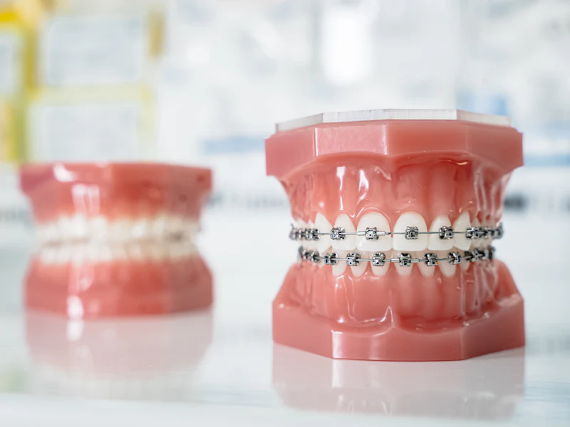Model teeth with metal braces fixed across the front teeth